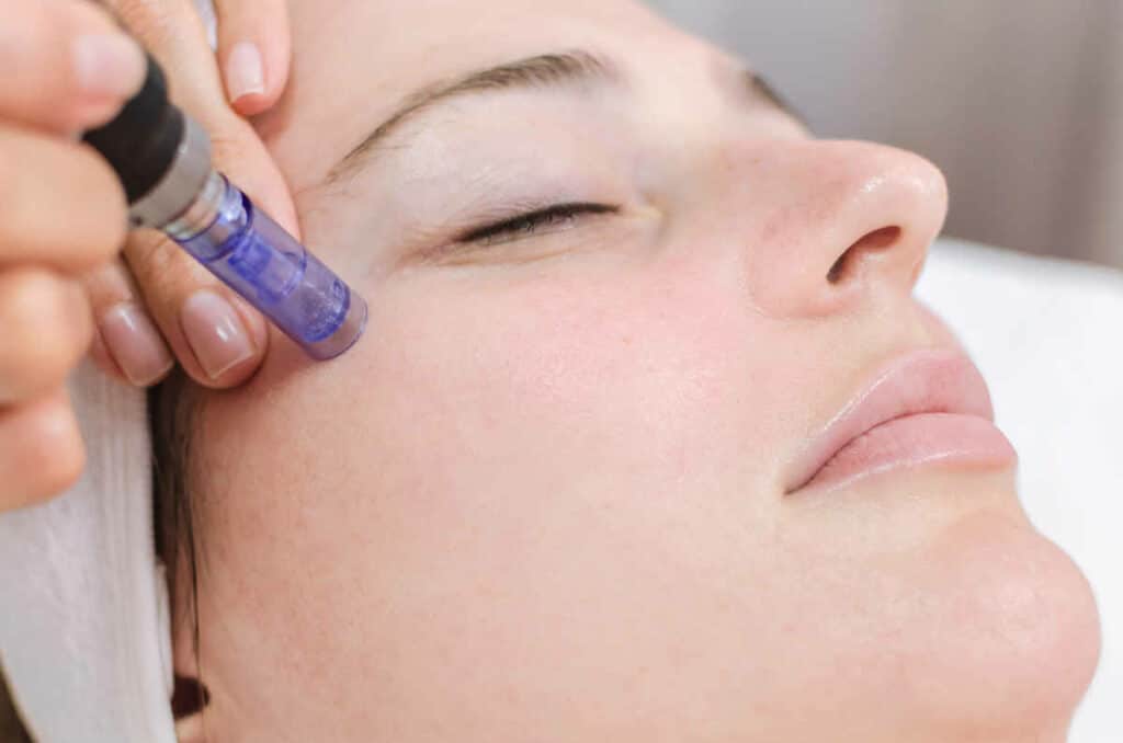 microneedling 1024x678 1